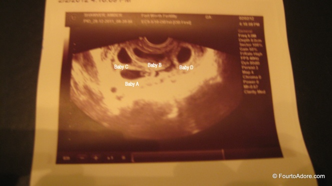 This was our first ultrasound and the only time all four babies were captured in one image.